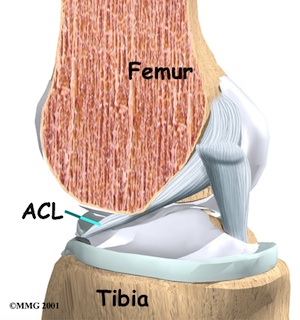 ACL Tear ACL Tear